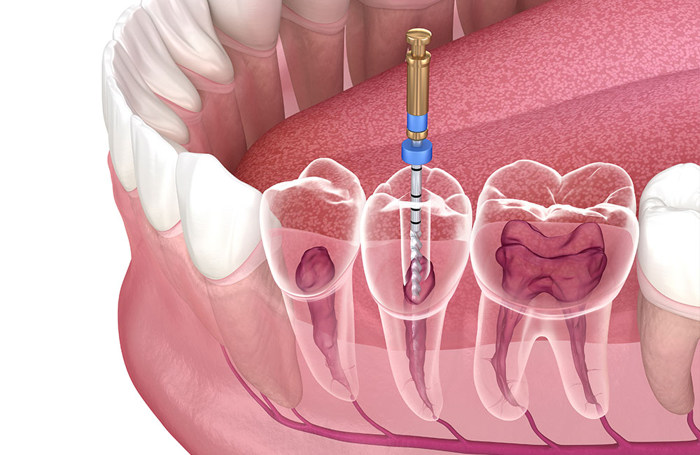 Endodonzia