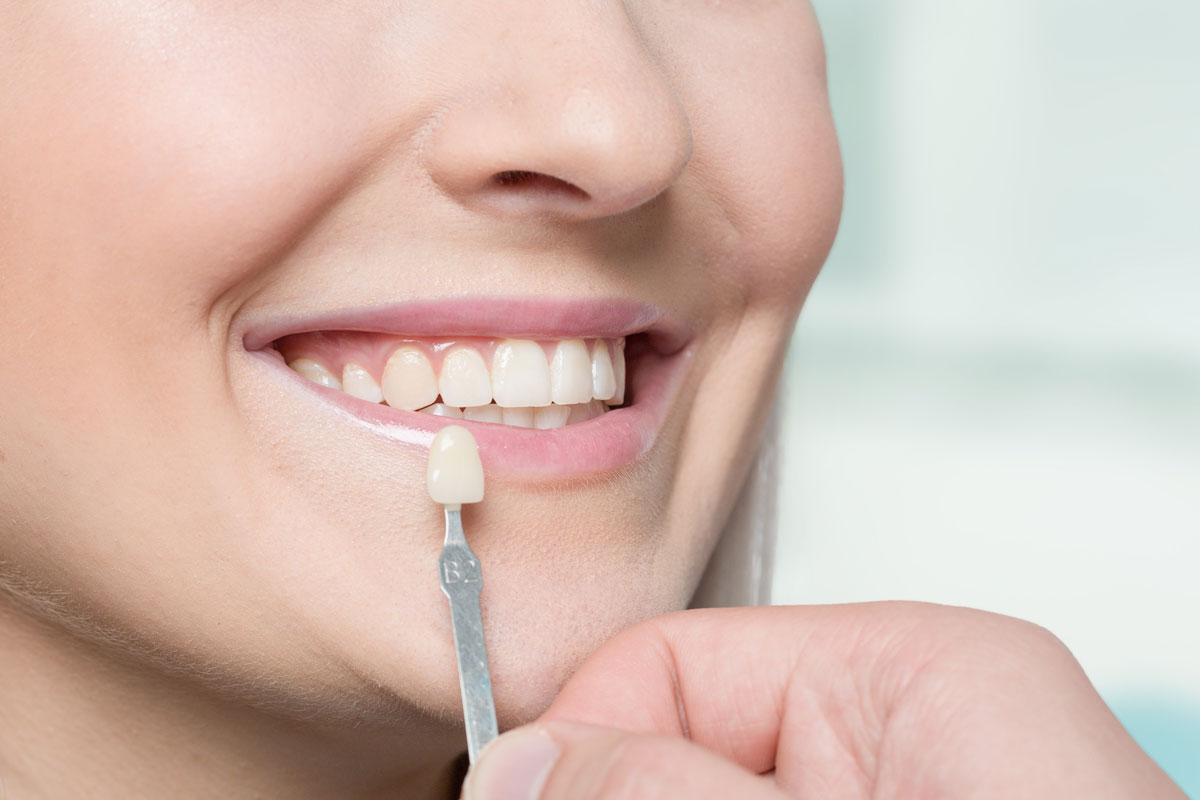 Close up ragazza che prova faccette dentali